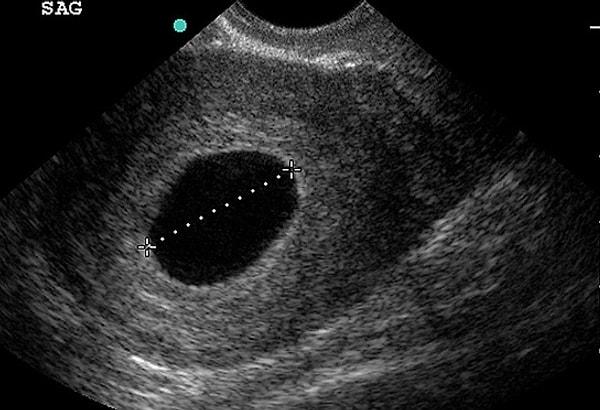 Gebelikte bu haberi aldıktan sonra ultrasonda kesenin görünmesi önemlidir fakat ne yazık ki boş gebelikte bu kese görünüyor, yani daha da fazla umutlanmanıza sebep oluyor.