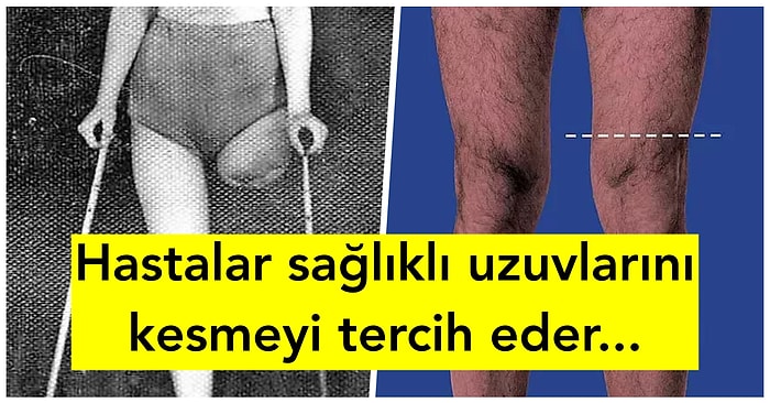 Kişinin Herhangi Bir Uzvunu Kendine Ait Hissetmemesine Neden Olan Bi’ Garip Rahatsızlık: ‘Apotemnophilia’