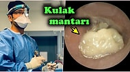Aşırı Airpod Kullanımından Dolayı Nasıl Kulak Mantarı Oluştuğunu Gösteren Doktor