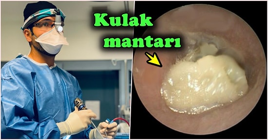 Aşırı Airpod Kullanımından Dolayı Nasıl Kulak Mantarı Oluştuğunu Gösteren Doktor