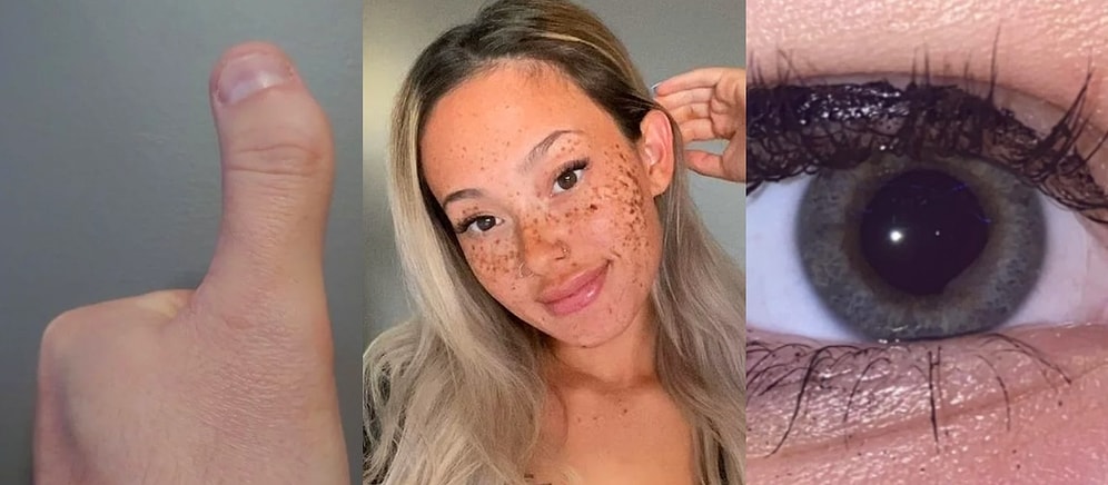 Sahip Oldukları Birbirinden Enteresan Genetik Mutasyonlarla Gören Herkesi Hayrete Düşüren 18 Kişi