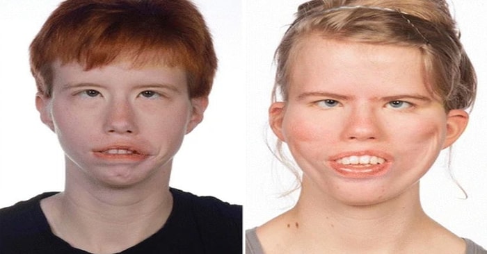 Doğuştan Gelen Bir Anormali Olan ve Kendini Yüz Felci Şeklinde Gösteren Poland-Möbius Sendromu Nedir?