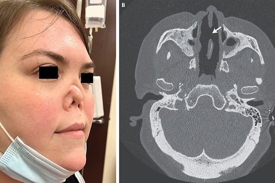 Nadir Görülen Hastalık, Genç Kadının Burnunun Çökmesine Neden Oldu...