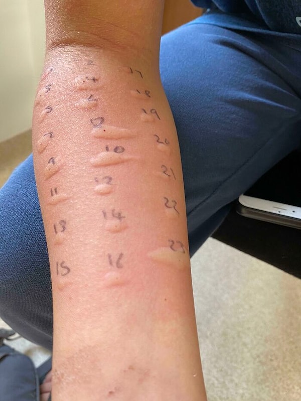 10. У моего 12-летнего ребенка аллергия почти на все