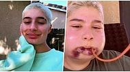 Aman Kimse Denemesin! Çene Ameliyatının Ne Kadar Tehlikeli Olabileceğini Göstererek Viral Olan Genç Kız