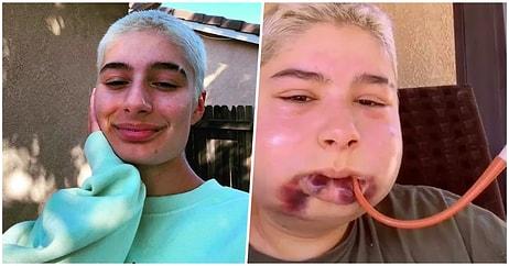 Aman Kimse Denemesin! Çene Ameliyatının Ne Kadar Tehlikeli Olabileceğini Göstererek Viral Olan Genç Kız