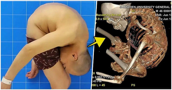 28 Yıl Boyunca Düz Bir Şekilde Duramadığı İçin Acı Çeken Çinli Adamın Yürek Burkan Hikayesi