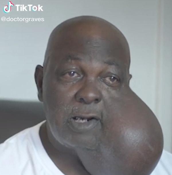 TikTok'ta bir doktor yüzünde dünyanın en büyük tümörlerinden biri olan bir hastanın ameliyatını yapacağını anlattığı bir video paylaştı.