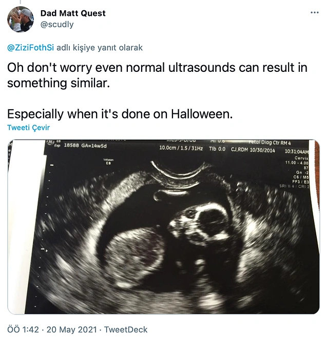 Endişelenmeyin bazen ultrason görüntüleri bile aynı şekilde sonuçlanabiliyor.