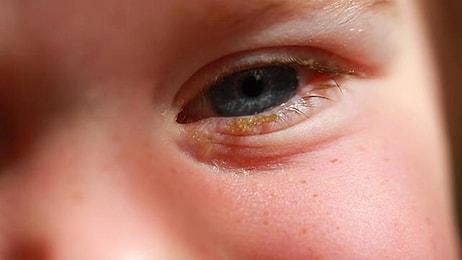 Bebeklerde Göz Kaşıntısı ve Kızarması Nedenleri Nelerdir? Bebeklerde Göz Kaşıntısı Nasıl Tedavi Edilir?