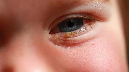 Bebeklerde Göz Kaşıntısı ve Kızarması Nedenleri Nelerdir? Bebeklerde Göz Kaşıntısı Nasıl Tedavi Edilir?