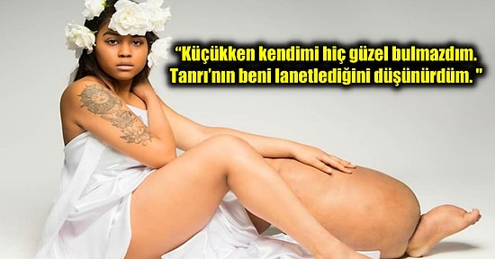 Lenfödem Hastası Olmasına Rağmen Zorluklara Boyun Eğmeyerek Modellik Yapmaya Devam Eden Mahonagy Geter