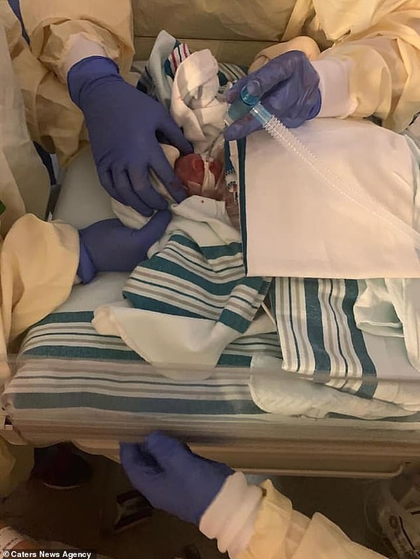 При рождении Деклан весил 652 грамма, Роуэн - 481 грамм, а крохотный Киан весил всего 453,5 грамма.