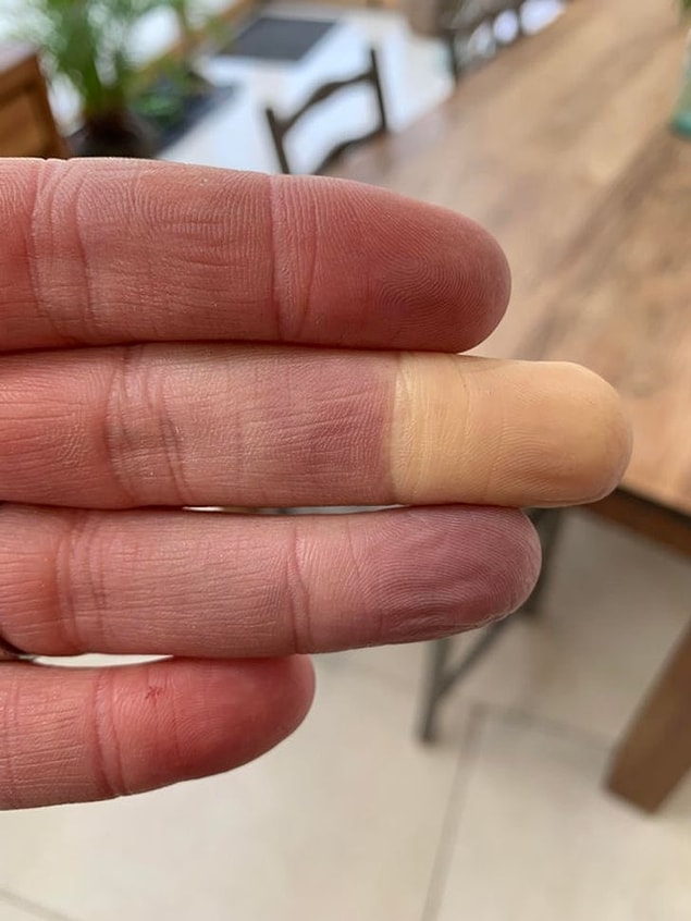 7. "Raynaud hastalığı."
