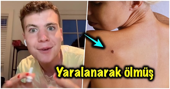 Sahip Olduğumuz Doğum Lekelerinin Önceki Hayatımızda Nasıl Öldüğümüzü Gösterdiğini İddia Eden Adam!