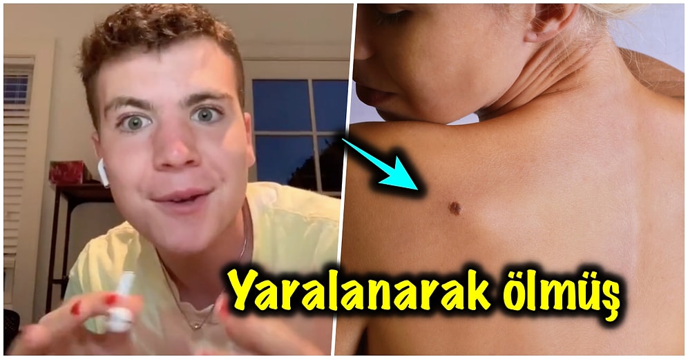 Sahip Olduğumuz Doğum Lekelerinin Önceki Hayatımızda Nasıl Öldüğümüzü Gösterdiğini İddia Eden Adam!