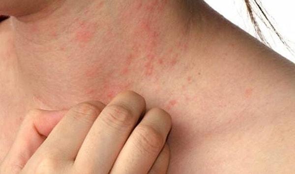 10. Kullanılan alerji ilaçları, aşının öncesinde ya da sonrasında bırakılmalı mı?