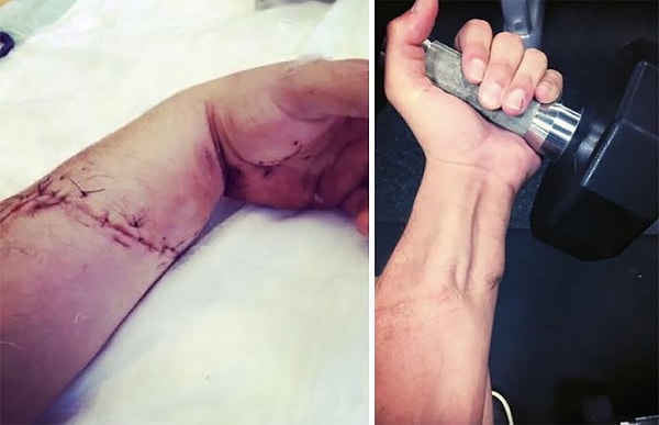 12. Никогда не думал, что смогу снова использовать свою руку. Респект хирургу и терапевту