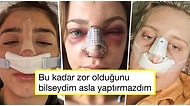 Göründüğü Kadar Kolay Değilmiş! Burun Estetiği Sonrası Geçirdikleri Zorlu Sürecin Fotoğrafını Paylaşan Kişiler