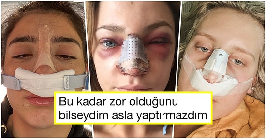 Göründüğü Kadar Kolay Değilmiş! Burun Estetiği Sonrası Geçirdikleri Zorlu Sürecin Fotoğrafını Paylaşan Kişiler