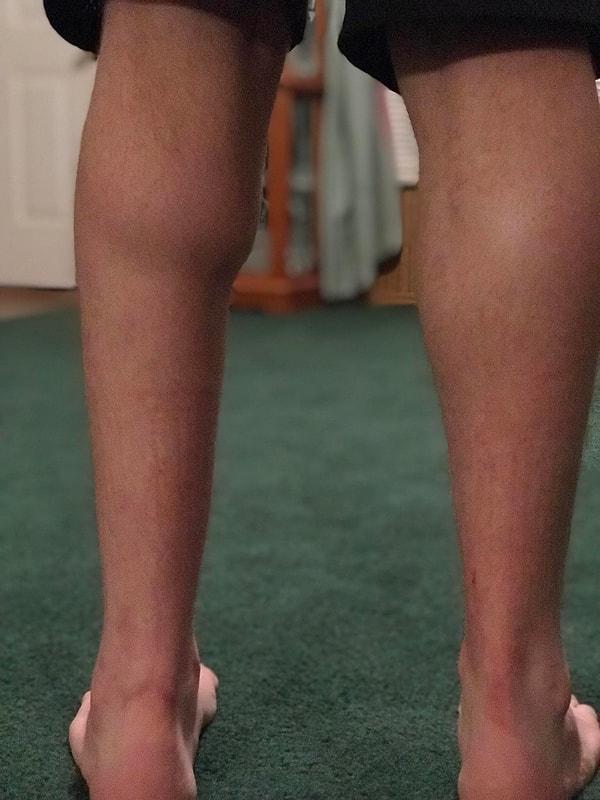 16. "Aşil tendonum koptuktan sonra bacaklarımın arasındaki fark."