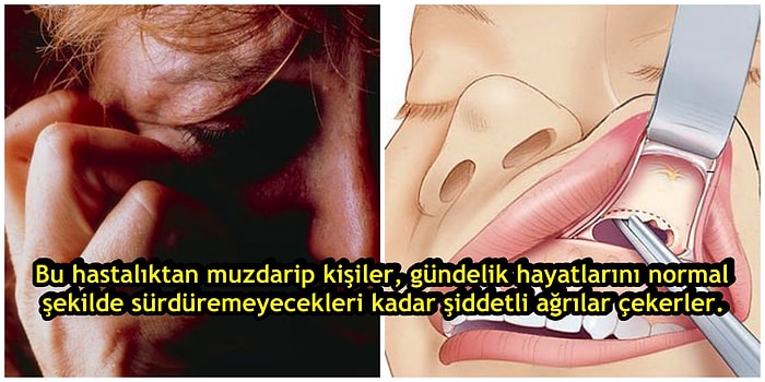 İnsanı İntihara Sürükleyecek Kadar Şiddetli Ağrılara Sebep Olan Hastalık: Trigeminal Nevralji