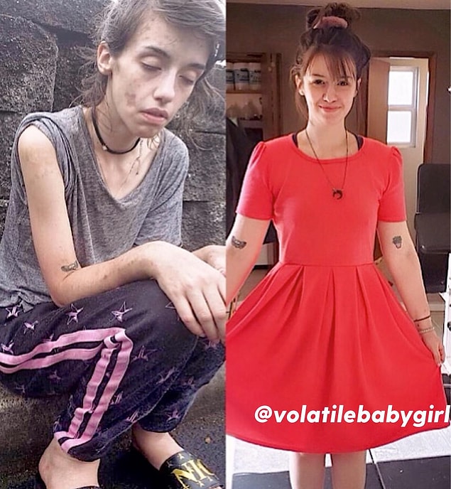 19. Bir kadının rehabilitasyondan önceki ve sonraki hali: