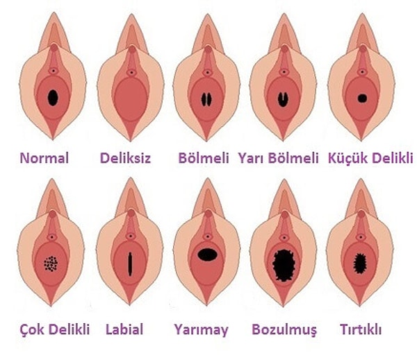 Türkiye'de birçok kişinin stresini yaşadığı kızlık zarı, aslında doğru sanılan yanlışlardan dolayı büyük bir şeymiş gibi algılanıyor.