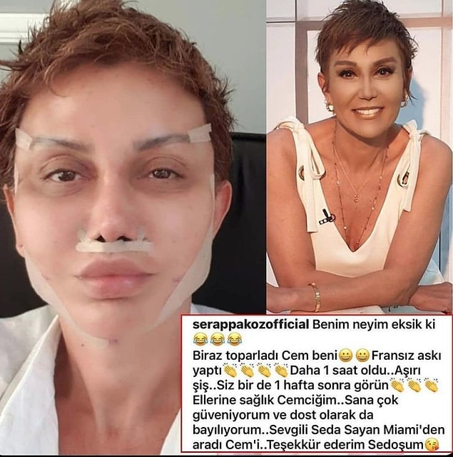 4. Ünlü sunucu Serap Paköz, Seda Sayan'ın doktoruna giderek fransız askı yöntemiyle yüzünü gerdirdi.
