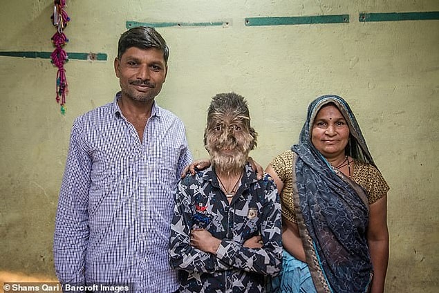 Hindistan'da yaşayan 13 yaşındaki Lalit Patidar, insanlar tarafından maymun olarak adlandırıldığını söyledi.