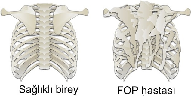1. Fibrodysplasia Ossificans Progressiva (Taş Adam Sendromu/FOP)