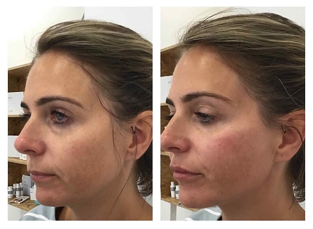 Yüzün belli bölgelerine azar azar uygulanarak yüzü rahatlatan "baby botox" uygulamasının dolgu versiyonu gibi düşünülebilir.