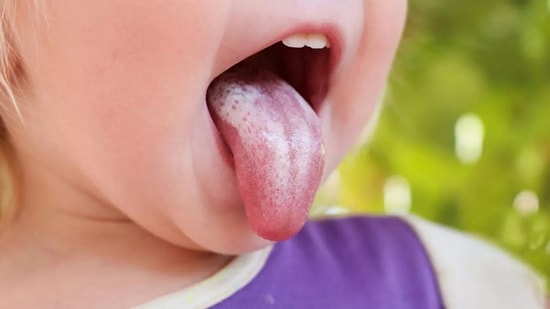 Pamukçuk Nedir? Pamukçuk Belirtileri ve Tedavisi…