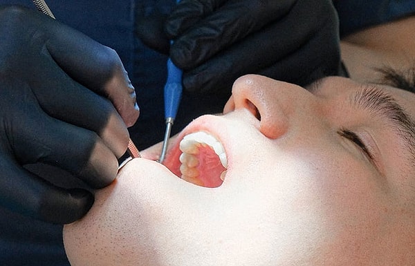 14. У 35% людей нет зубов мудрости