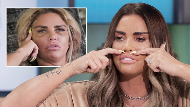 17 yaşından beri sayısız estetik operasyon geçiren ve şu an 43 yaşında olan ünlü İngiliz model Katie Price şöhretini estetiğe borçlu olduğunu söylüyor.