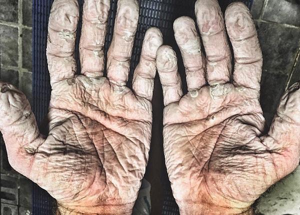 13. Olimpik kürekçi Alex Gregory'nin saatlerce ıslak eldiven giydikten sonra elleri: