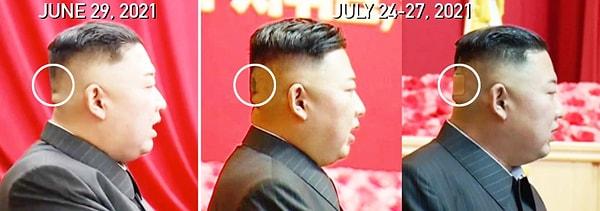 29 Haziran'daki bir politbüro toplantısında o yeşilimsi ize dair herhangi bir şey yoktu. Kim'in 11 Temmuz'da müzisyenlerle yaptığı bir etkinlikten yayınlanan fotoğrafları kafasının arkasını göstermedi.