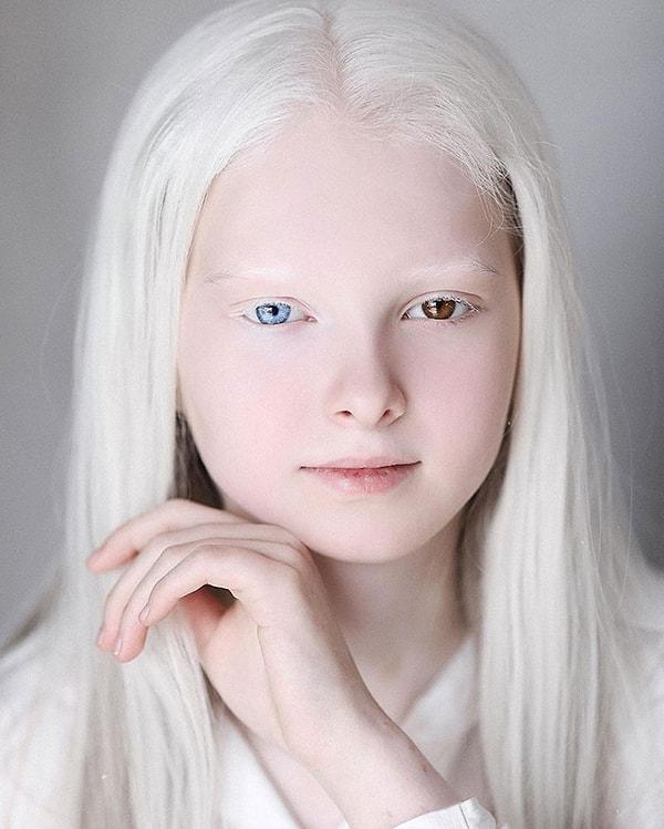 1. Amina Ependieva'nın iki nadir genetik durumu var: Albinizm ve Heterokromi.