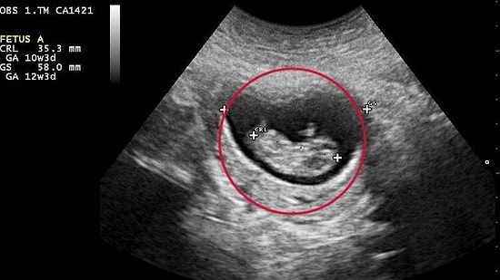 Gebelik Kesesi Ne Zaman Görülür?