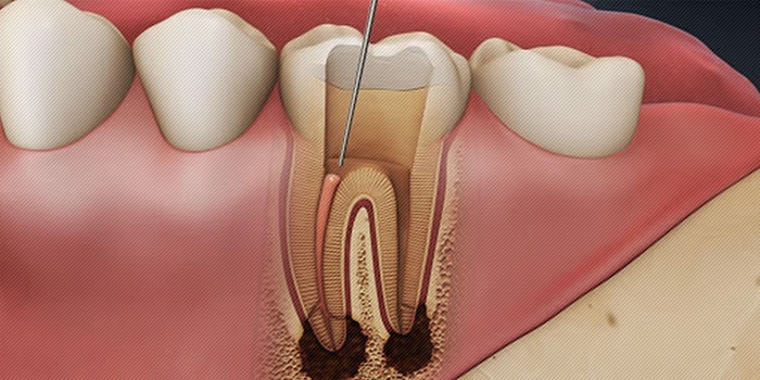 Kanal Tedavisi Nedir? Kanal Tedavisi Ne Kadar Sürer, Acıtır mı?