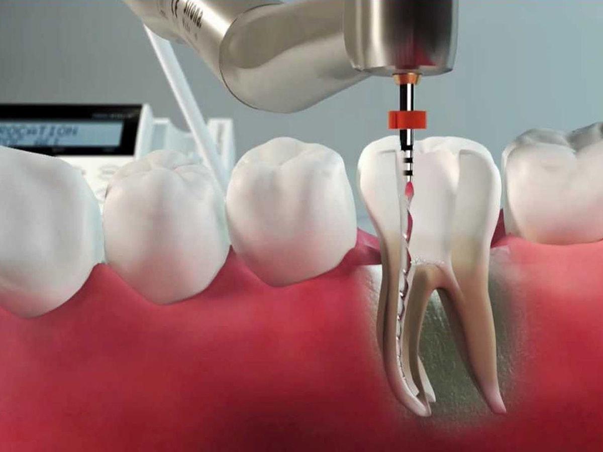 Расширенное настоящее. Эндодонтическое перелечивание зубов. Пульпит корневого канала. 4 Канальный пульпит зуба.