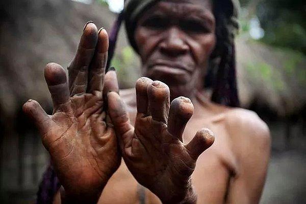 9. Endonezya'da aile üyesi öldüğünde parmağın bir kısmı kesiliyor.