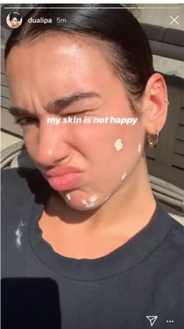 8. Ünlü şarkıcı Dua Lipa'nın cilt sorunlarıyla uğraştığını takipçileriyle paylaşması: