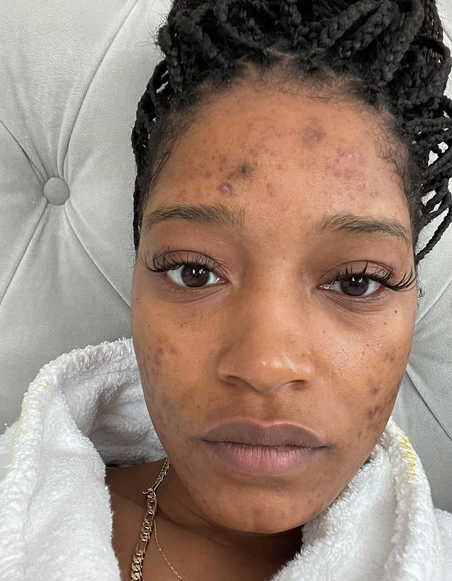 15. Keke Palmer'ın polikistik over sendromu (PCOS) ile ilgili deneyimini ve bunun cildini nasıl etkilediğini takipçileriyle paylaşması: