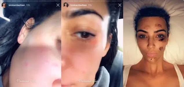 24. Kim Kardashian'ın bu sorununu çoğu kişi bilmiyordur. Kendisi Instagram'da sedef hastalığının nasıl göründüğünü takipçileriyle paylaşmıştı: