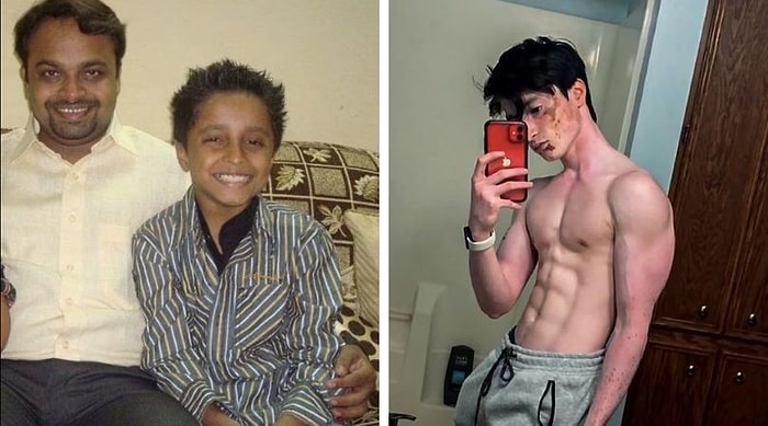 Болезнь витилиго изменила цвет кожи подростка из Индии настолько, что люди думают, он усыновлен или альбинос