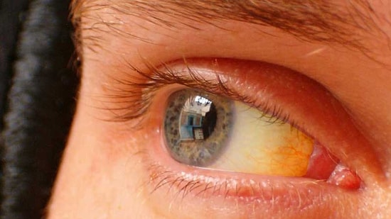 Sarılık Nedir? Sarılık Belirtileri ve Tedavisi...