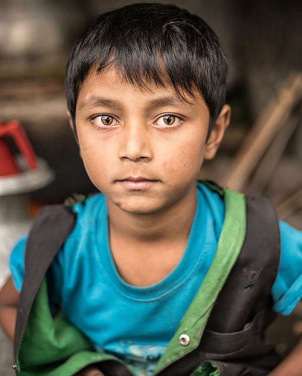 9. Редкая генетическая особенность, известная как синдром кошачьего глаза