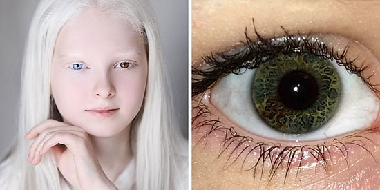 20 фотографий уникальных людей c редкими генетическими особенностями