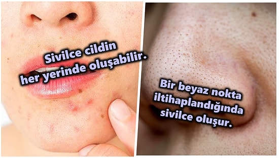 Ergenliğe Girdiğimizden Beri Bir Türlü Peşimizi Bırakmayan Sivilce ve Siyah Noktaların Arasındaki Farklar